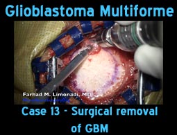 GBM case 13