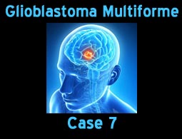 GBM case 7