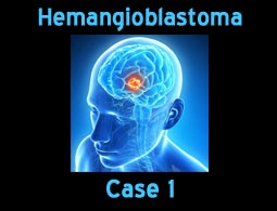 Hemangioblastoma case 1