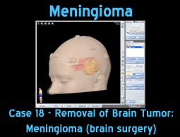 Meningioma case 17
