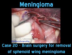 Meningioma case 20