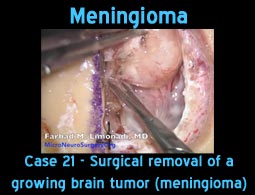 Meningioma case 20