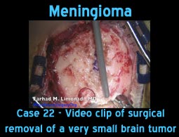 Meningioma case 22
