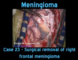 Meningioma case 23