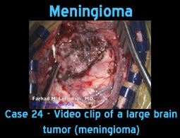 Meningioma case 23