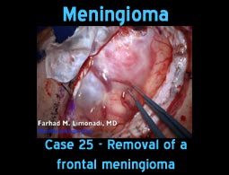 Meningioma case 25