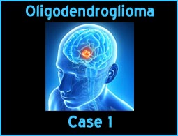 Oligodendroglioma case 1