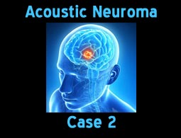 acoustic neuroma case 2
