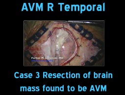 avm r temporal case 3