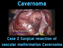 cavernoma case 2