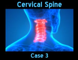 cervical spine case3