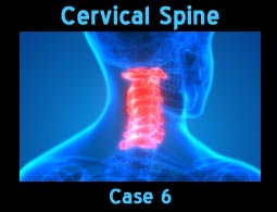 cervical spine case6