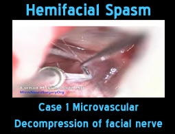hemifacial spasm case1
