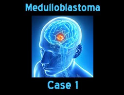 medulloblastoma case 1