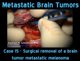 Metastatic case 15