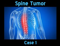 spine tumore case1