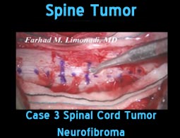 spine tumor case3