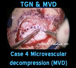 tgn mvd case4