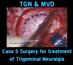 tgn mvd case5