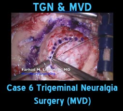 tgn mvd case6