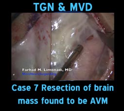 tgn mvd case7