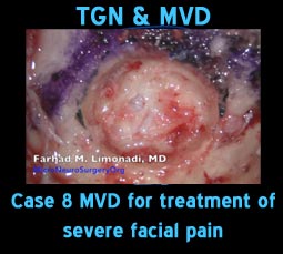 tgn mvd case8