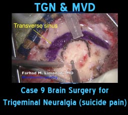 tgn mvd case9