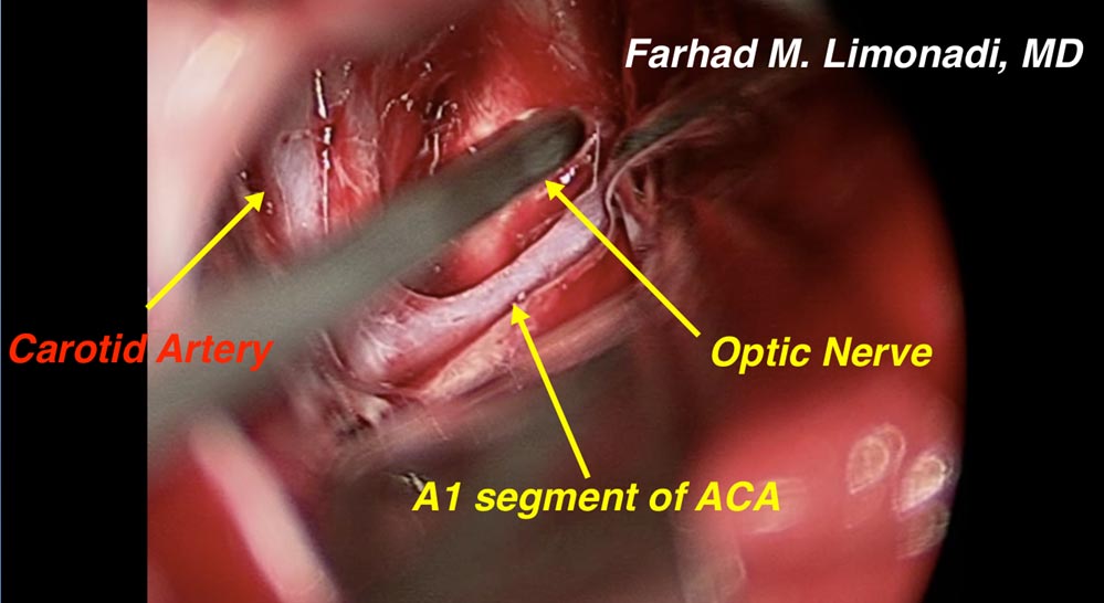 acom-case4-011