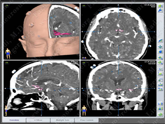 ACOM Case 3 Image 5