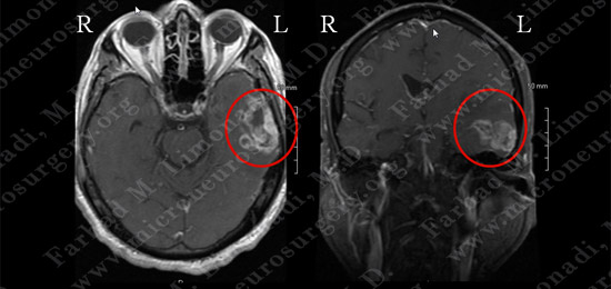 GBM_case6_image1