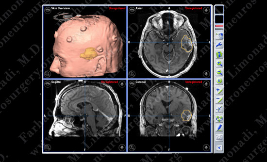 GBM_case6_image2