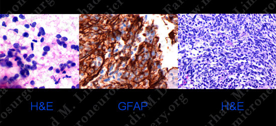 GBM_case6_image3