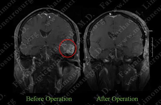 GBM case 6 image 5