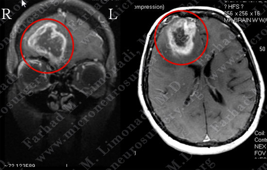 GBM_case7_image1