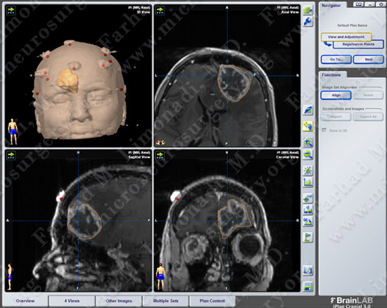 GBM_case7_image2