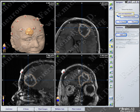 GBM_case7_image3