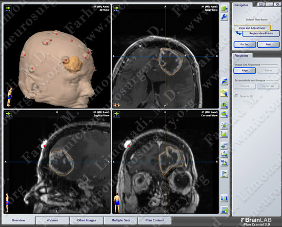 GBM_case7_image4