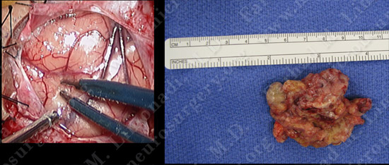 GBM_case7_image5