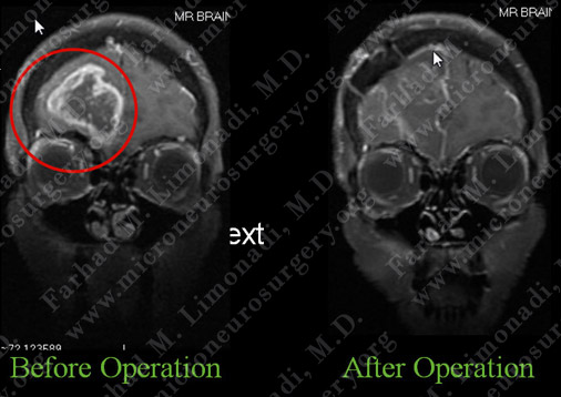 GBM_case7_image7