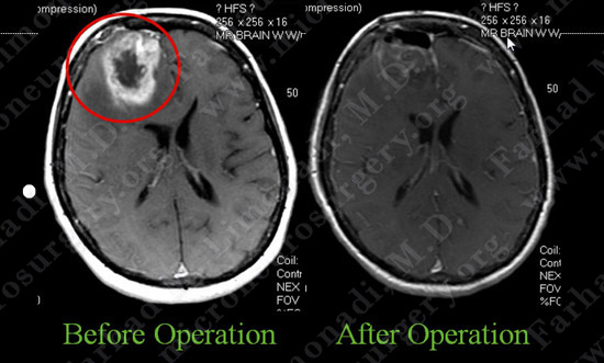GBM_case7_image8