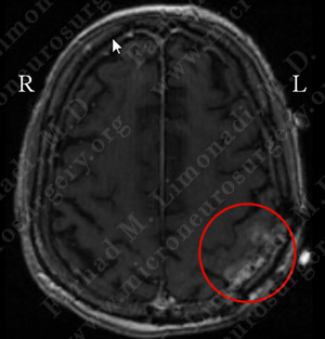 GBM_case8_image1