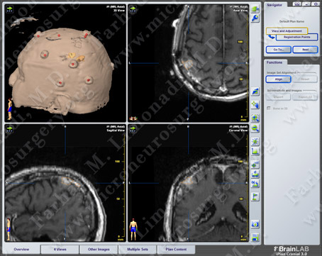 GBM_case8_image2