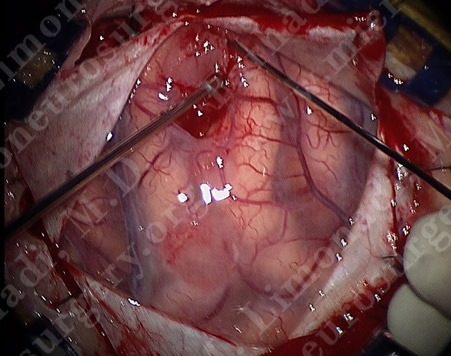 GBM_case8_image5