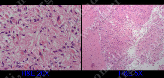 GBM_case8_image6
