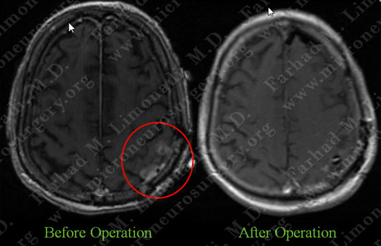 GBM_case8_image7