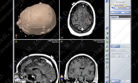gbm-case10-002
