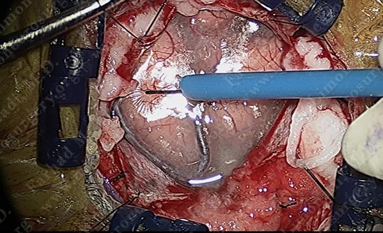 gbm-case10-004