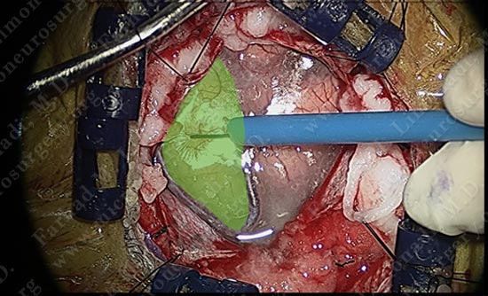 gbm-case10-005