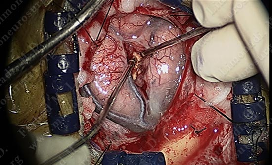 gbm-case10-009