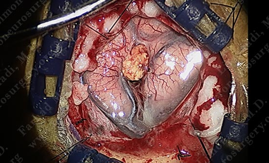 gbm-case10-010